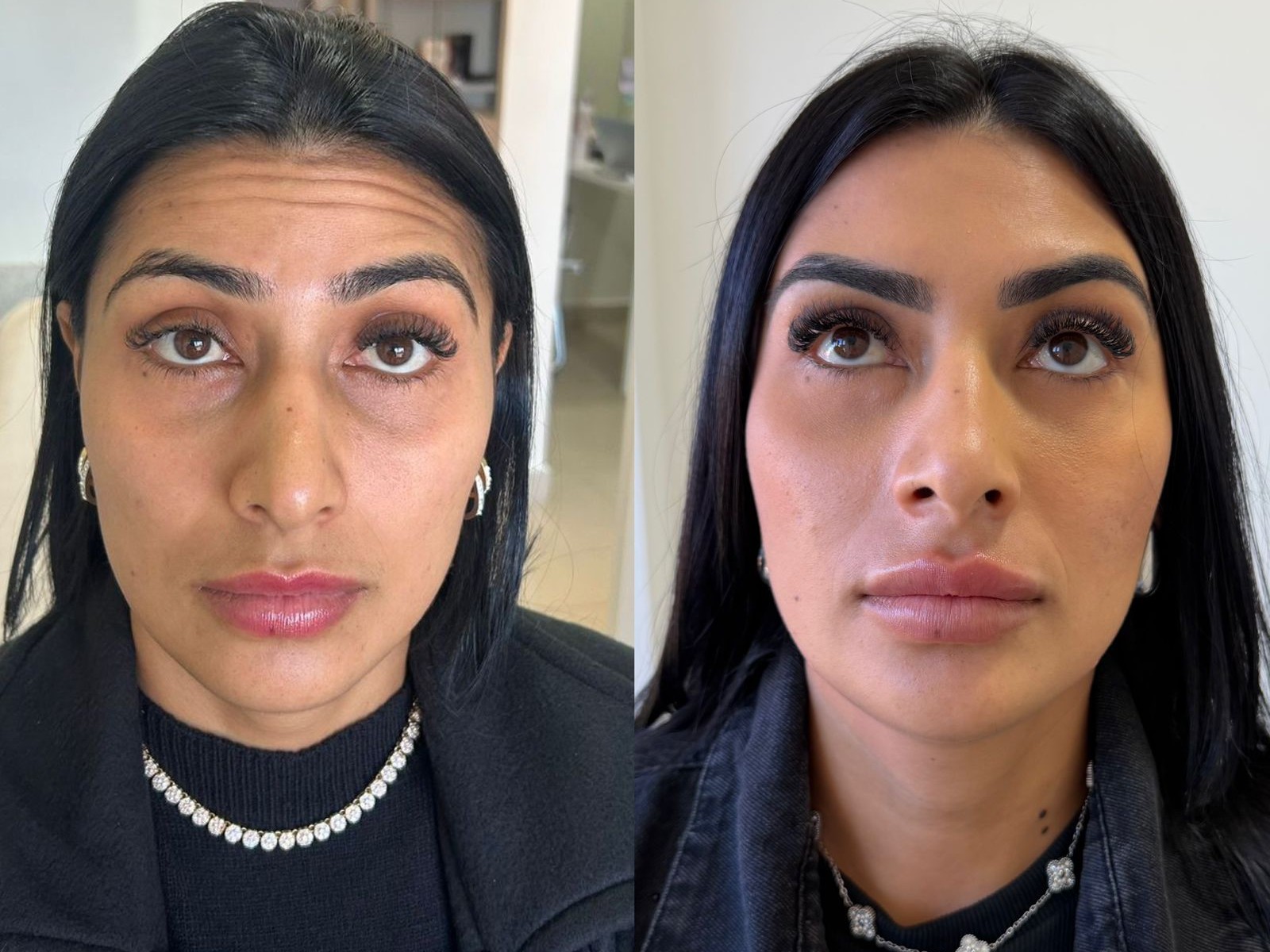 Resultado de Botox