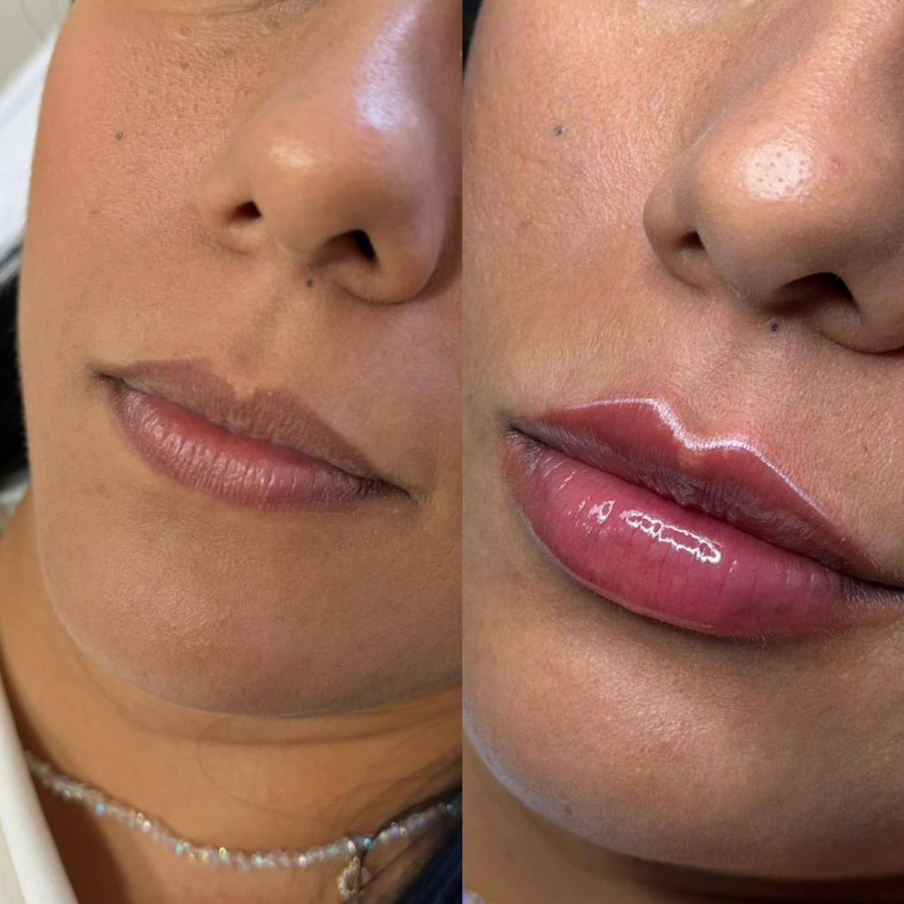 Antes e depois preenchimento labial